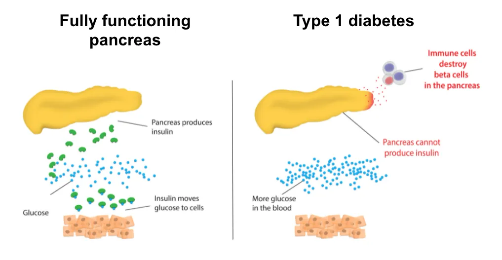 2584 diabetes honeymoon phase image 1
